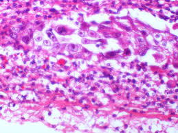 Tracheobronchitis